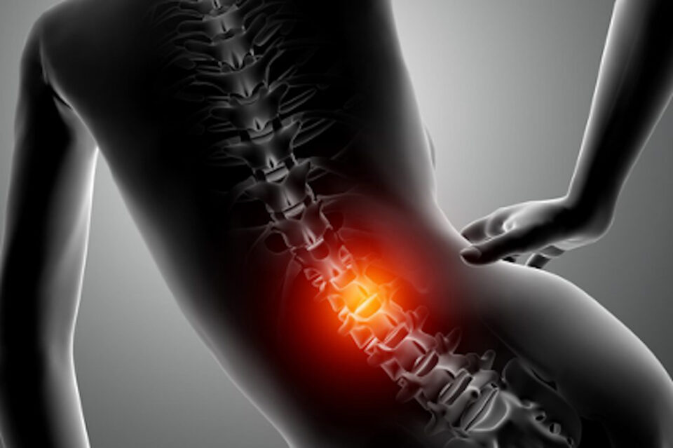 Tem como tratar hérnia de disco sem precisar de cirurgia?