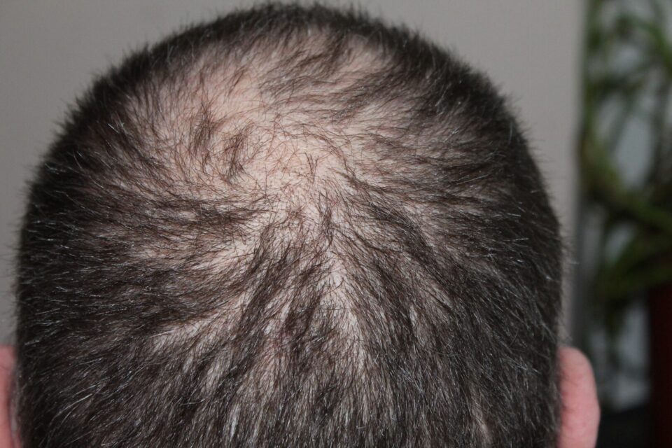 queda de cabelo minoxidil
