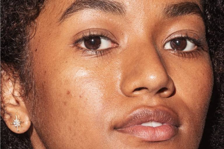 MELASMA