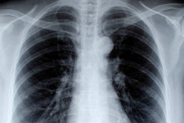 cancer-pulmao-novo-tratamento
