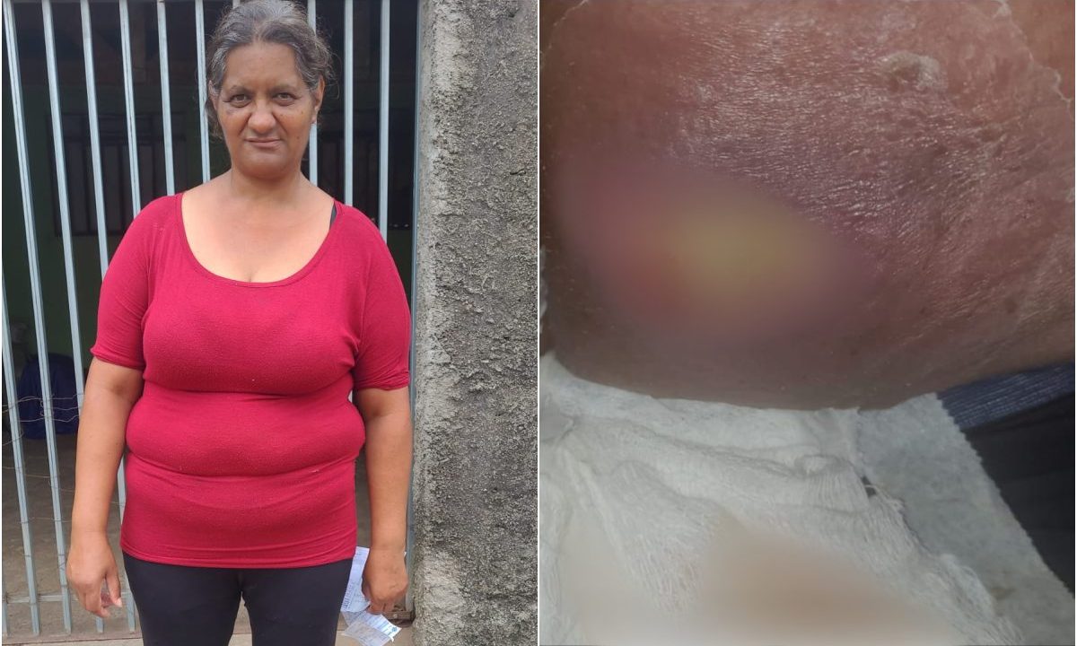 mulher-sofre-infecção-apos-benzetacil-sitio-cercado