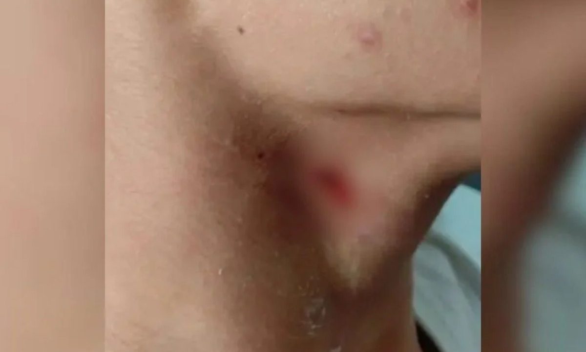 Pescoço machucado de aluno que teve percoço perfurado por colega com caneta
