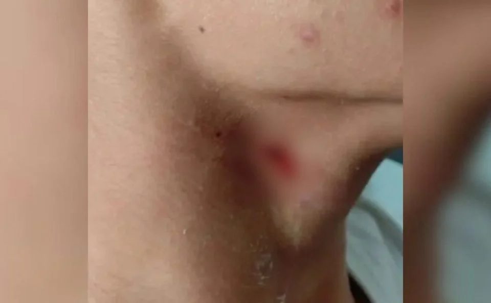 Pescoço machucado de aluno que teve percoço perfurado por colega com caneta