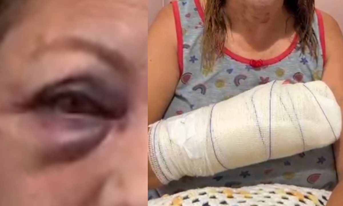 Foto da esquerda mostra o olho da vítima machucada após as agressões e a da direita o braço enfaixado