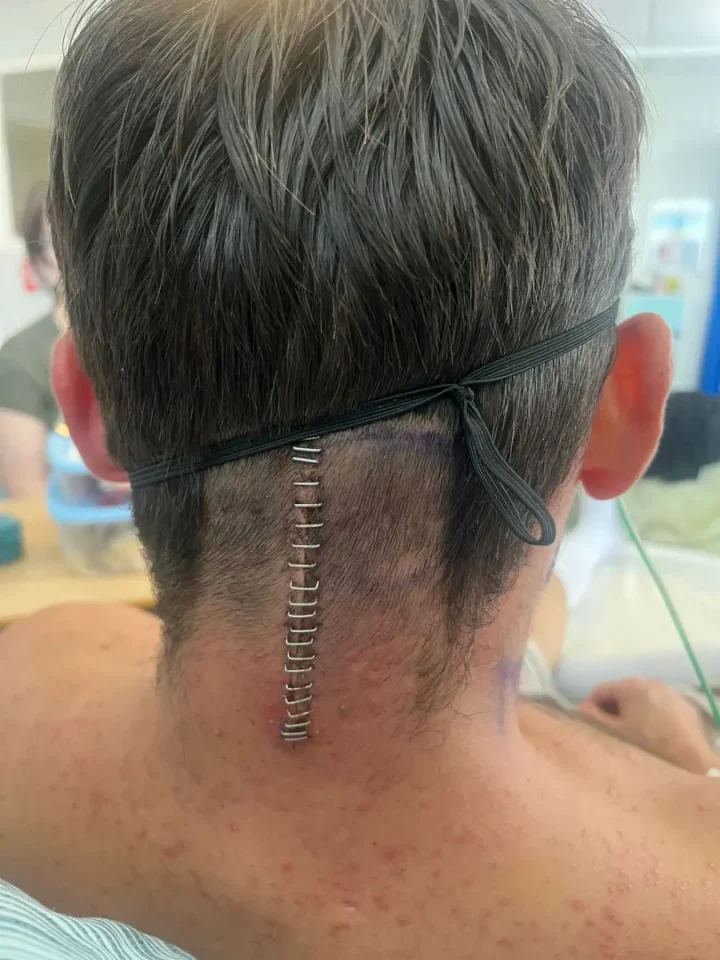 Imagem do pós-operatório do jovem que retirou tumor cerebral.