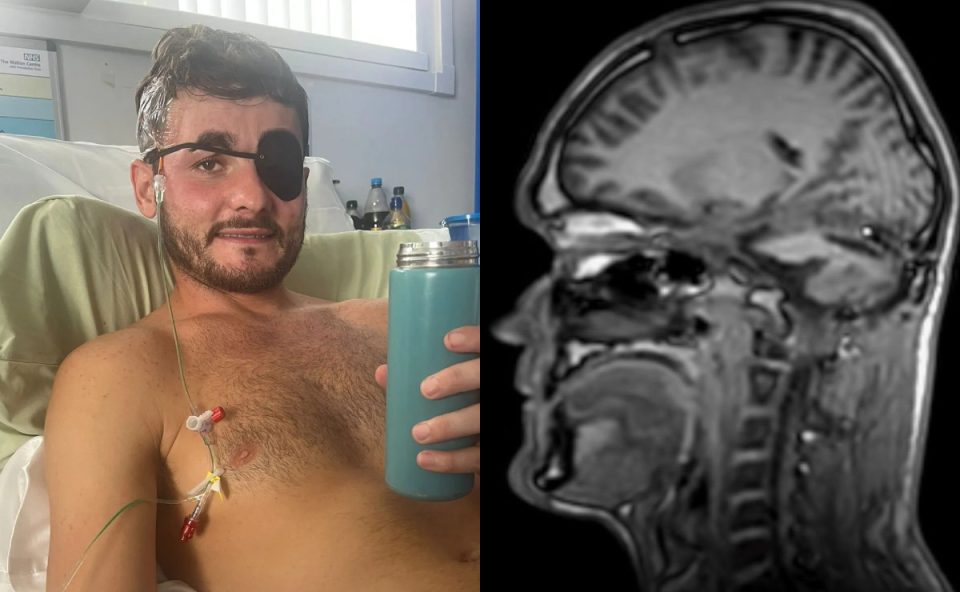 A colagem apresenta duas imagens, com o jovem Luke Taylor, diagnosticado com um tumor cerebral raro. Ele aparece deitado em uma cama com um tapa-olho, sem camisa e segurando um copo. Na segunda imagem, o resultado da ressonância magnética mostra o tumor no cérebro.