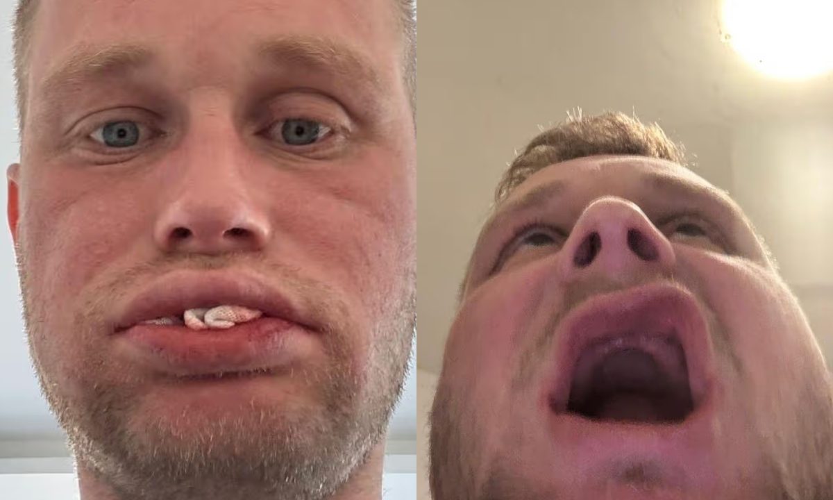 Foto de Jon Denton, que teve seu implante de dente arruinado. As fotos mostram ele abrindo a boca e mostrando a boca "vazia".