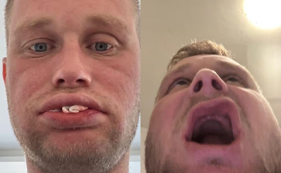 Foto de Jon Denton, que teve seu implante de dente arruinado. As fotos mostram ele abrindo a boca e mostrando a boca "vazia".