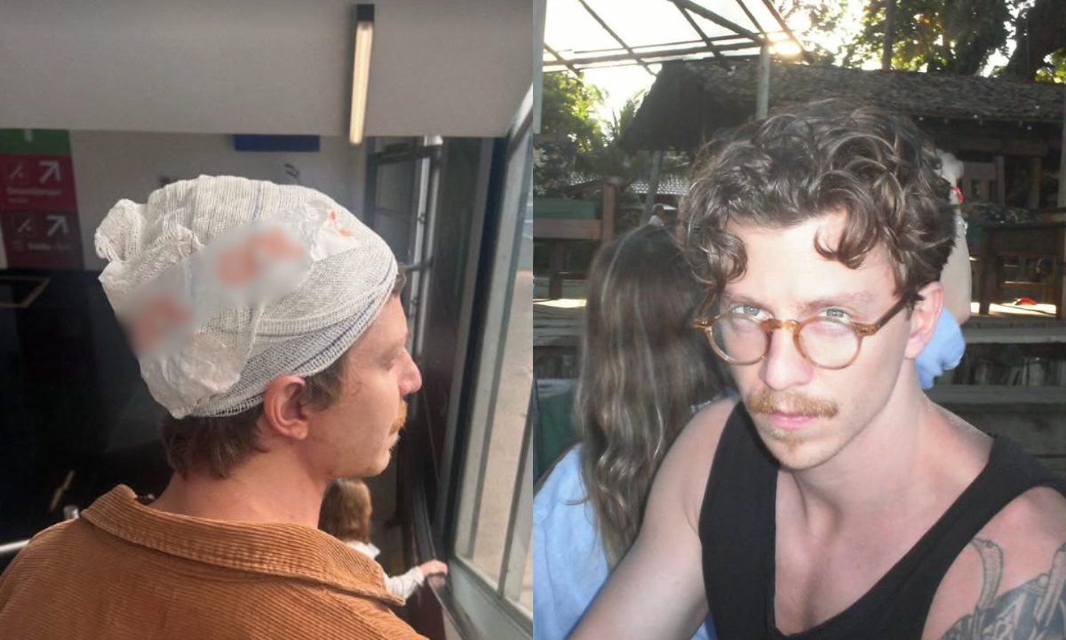 Vocalista da banda Scalene gustavo bertoni aparece com a cabeça enfaixada após sofrer queda durante show; ao lado, foto do cantor antes do acidente.