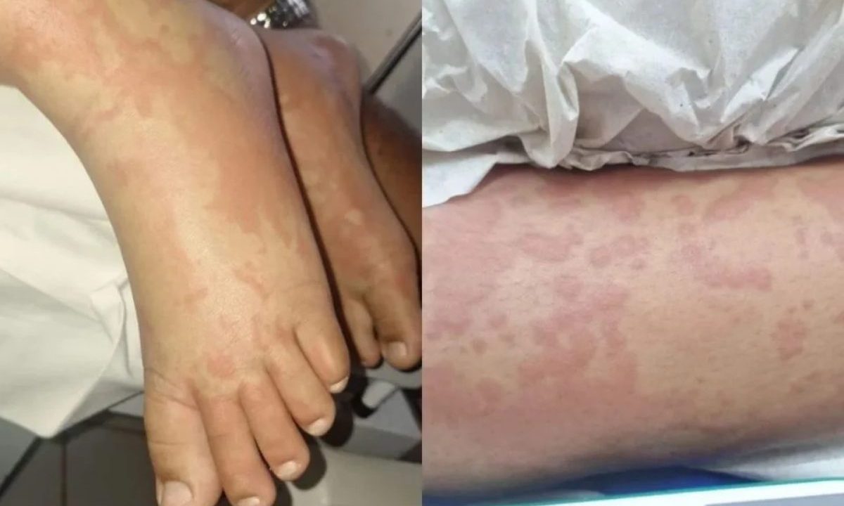 Manchas avermelhadas apareceram no corpo da criança internada no Rio Grande do Norte após quadro inicialmente associado a detergente investigado pela Anvisa.