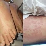 Manchas avermelhadas apareceram no corpo da criança internada no Rio Grande do Norte após quadro inicialmente associado a detergente investigado pela Anvisa.