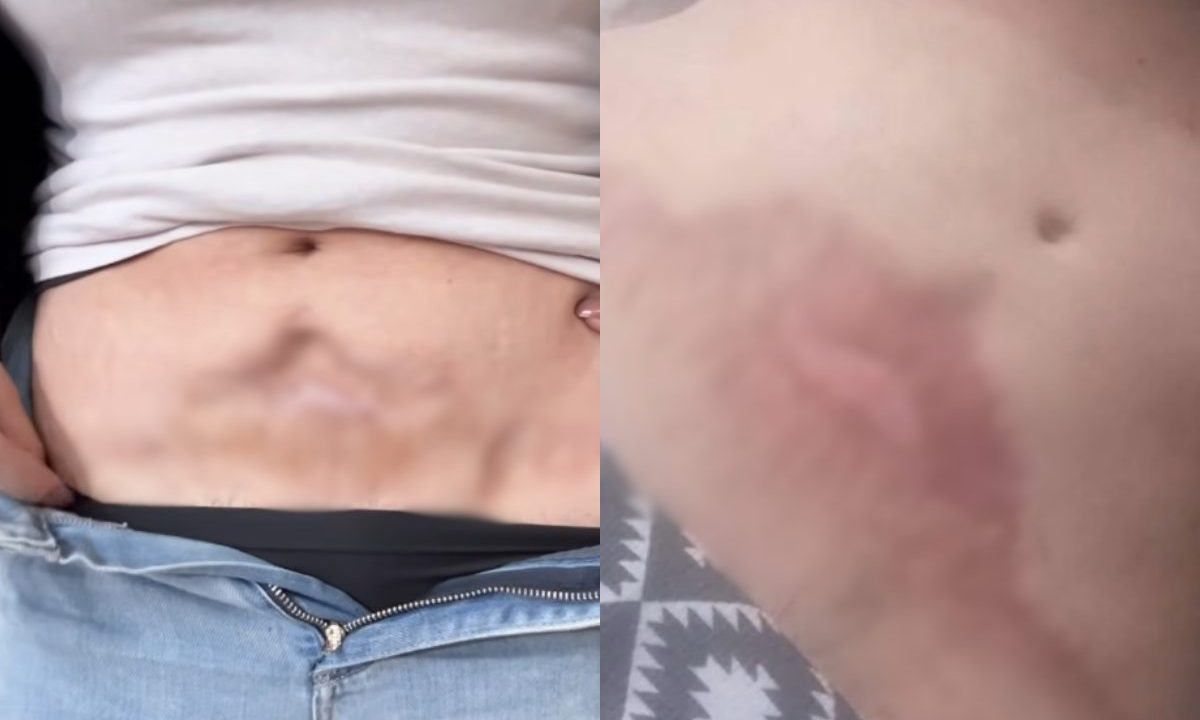 Imagem da mulher, que teve cirurgia plástica malsucedida.