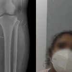 Montagem mostra, à esquerda, exame de raio-X com diversas agulhas espalhadas na região da perna. À direita, imagem da mulher investigada por fingir ser adolescente, usando máscara de proteção.