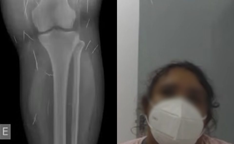 Montagem mostra, à esquerda, exame de raio-X com diversas agulhas espalhadas na região da perna. À direita, imagem da mulher investigada por fingir ser adolescente, usando máscara de proteção.